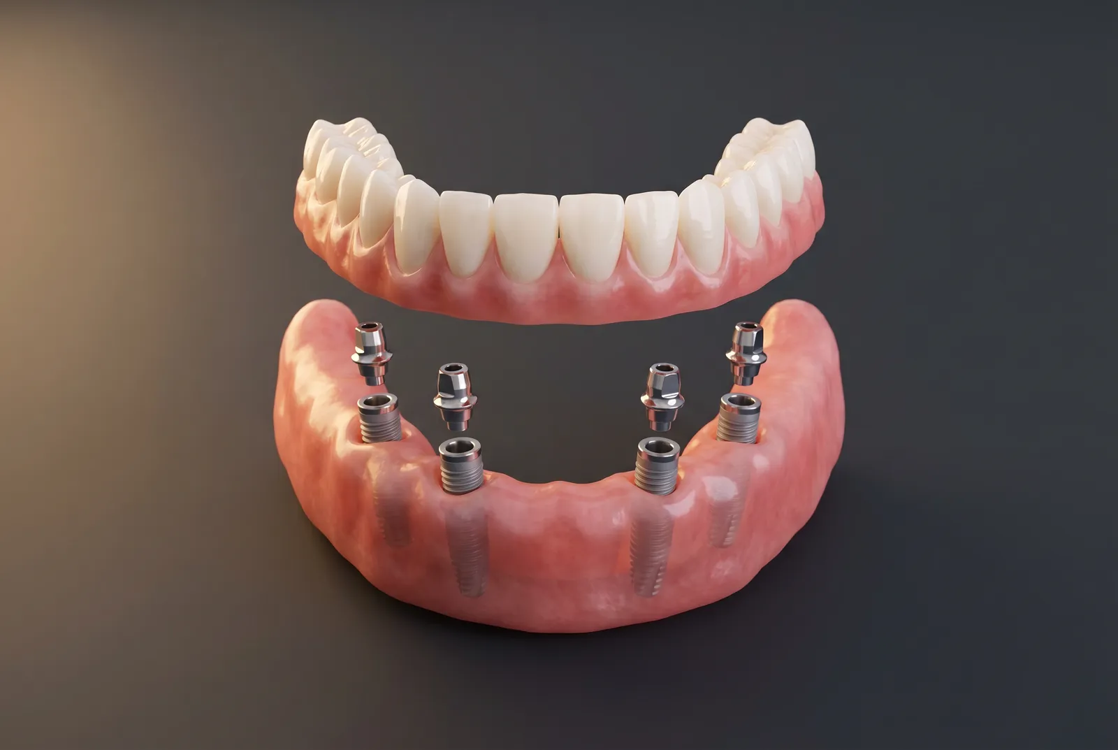 Implant-supported teeth / All-on-4