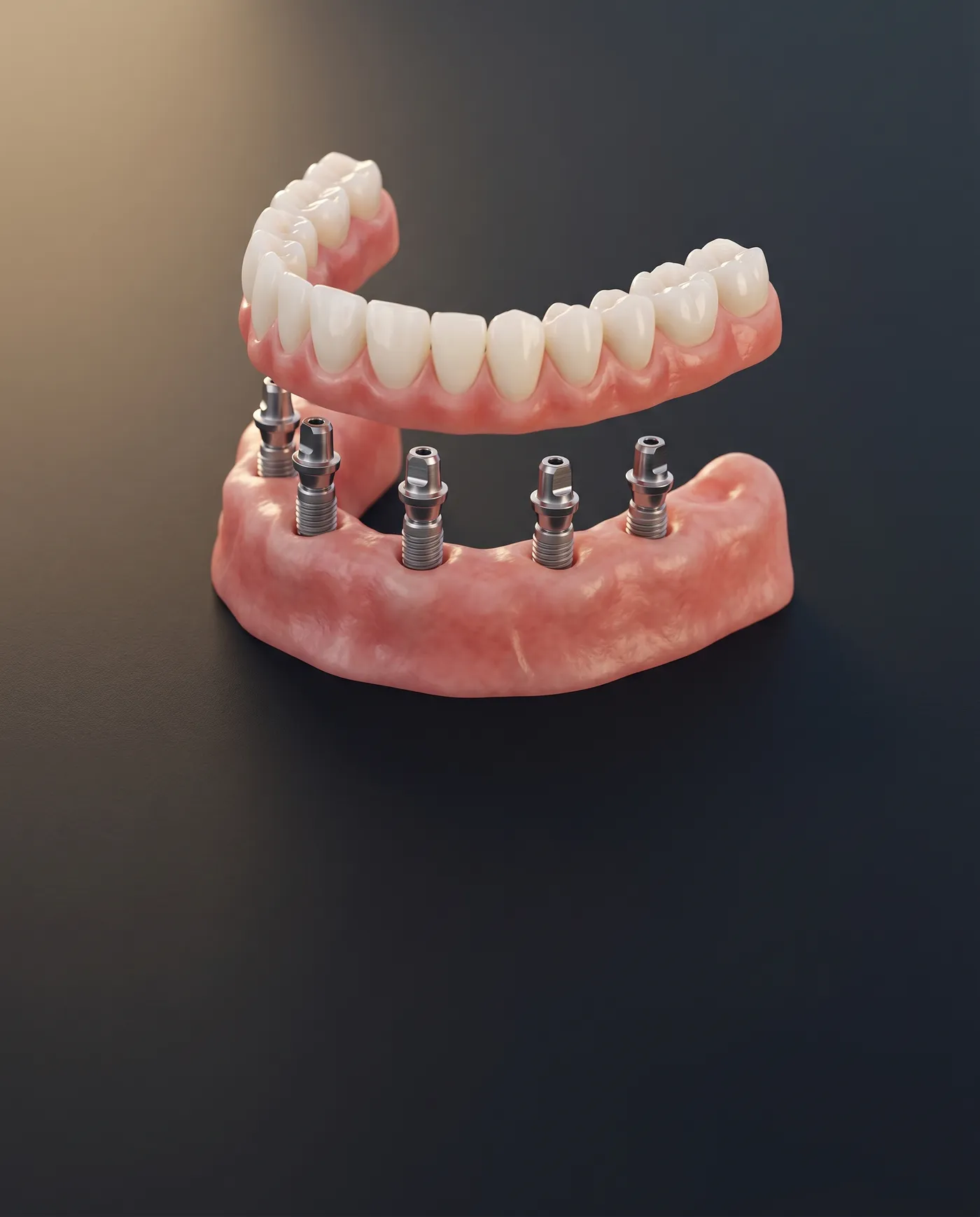 Full-mouth restoration / All-on-X