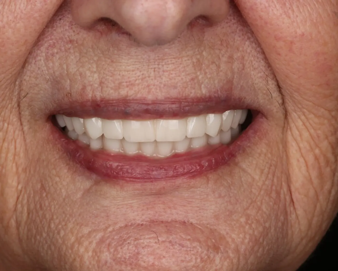 After: a full fixed arch of teeth on implants