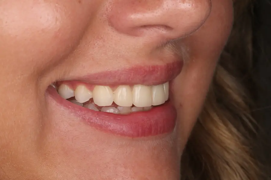 A finished result at Slobodian Dental