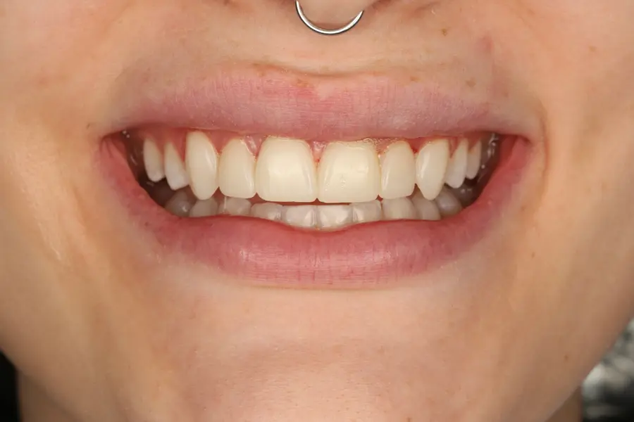 A finished result at Slobodian Dental