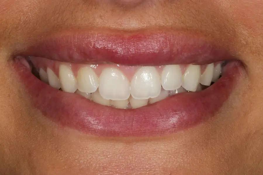 A finished result at Slobodian Dental